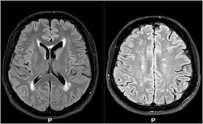 Case report: Cerebral autosomal dominant arteriopathy with subcortical infarcts and leucoencephalopathy (CADASIL) as a risk factor for central serous chorioretinopathy